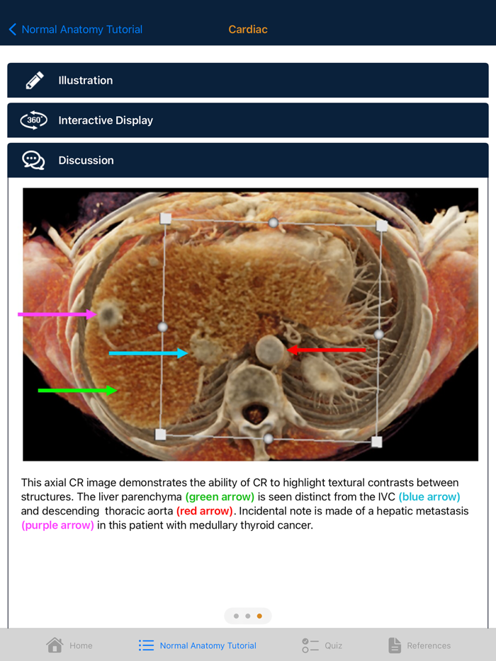 CTisus Chest Atlas 3D CRT