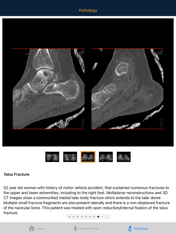 CTisus: CT of the Foot iPad screenshot 6 - Medical app