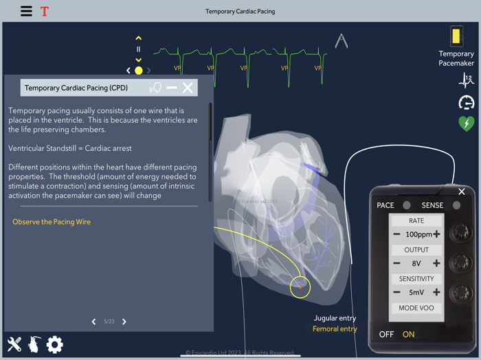 Temporary Cardiac Pacing