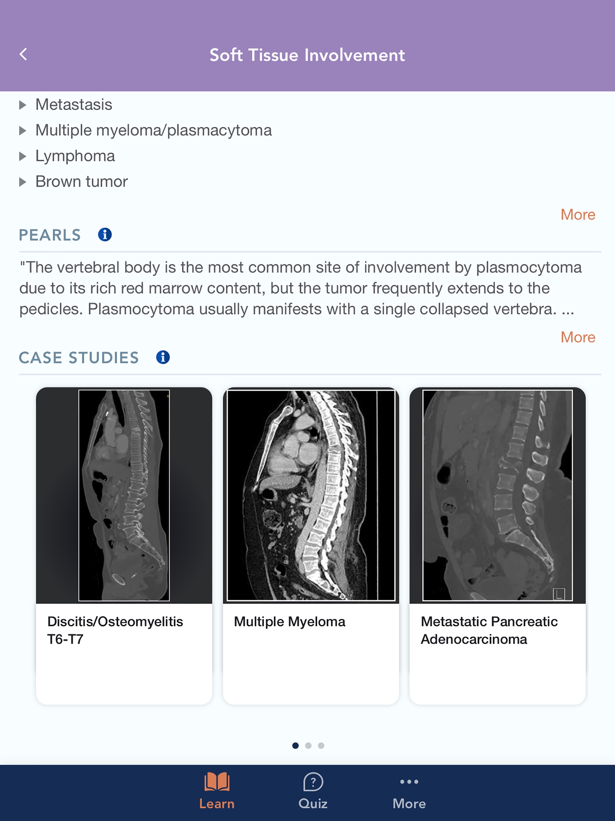 CTisus L-Spine Pathologyのおすすめ画像3