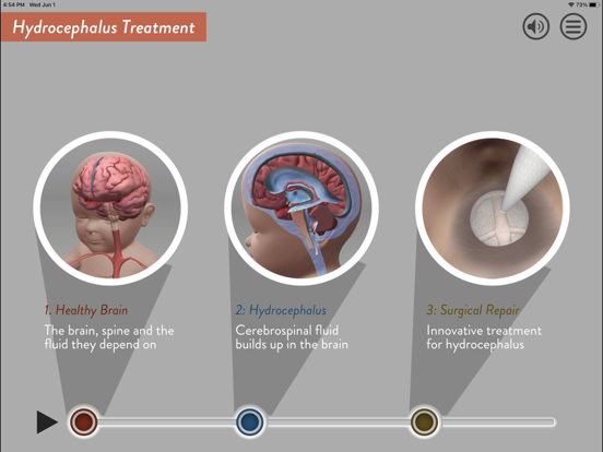 Screenshot #4 pour Hydrocephalus Procedure