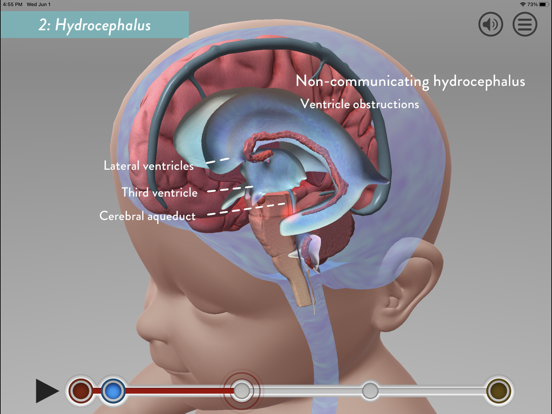 Screenshot #5 pour Hydrocephalus Procedure