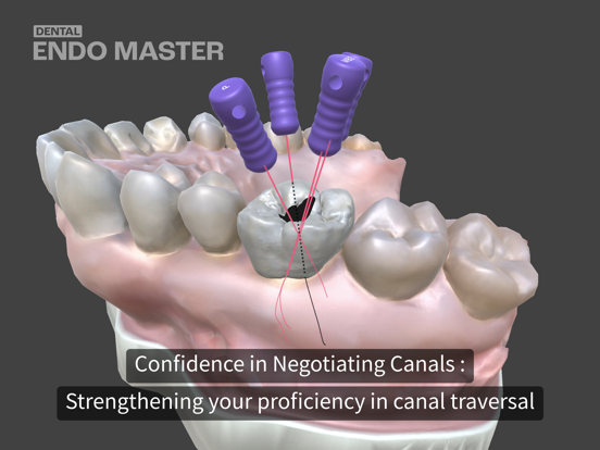 Dental EndoMaster iPad screenshot 5 - Medical app