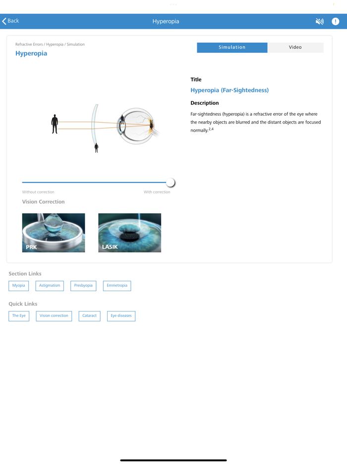 ZEISS Patient Counselling