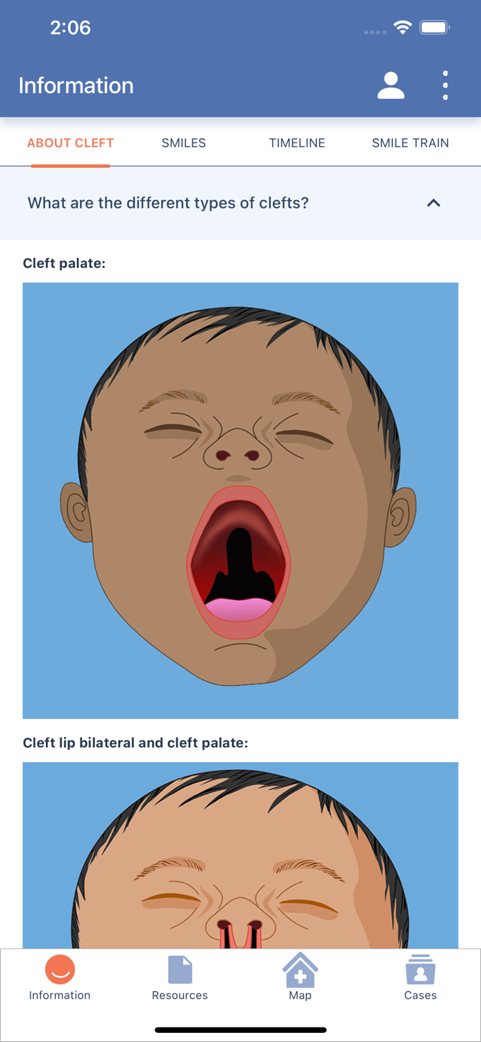 Cleft Care Companion