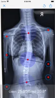 脊柱侧弯cobb角测量 iphone screenshot 2