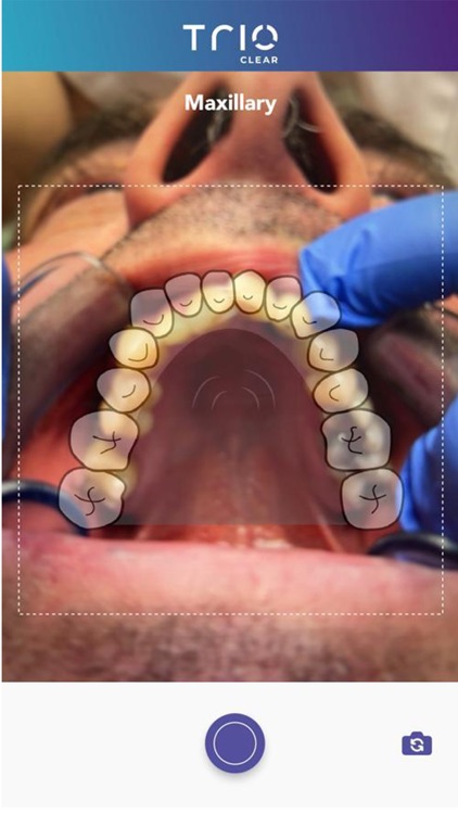 TrioClear Aligner