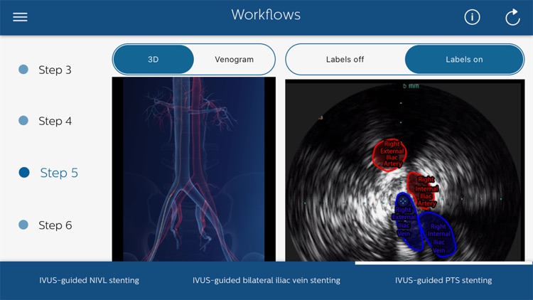 Philips Venous IVUS Tutor