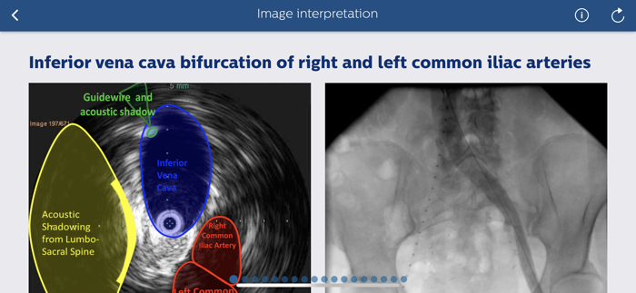 Philips Venous IVUS Tutor