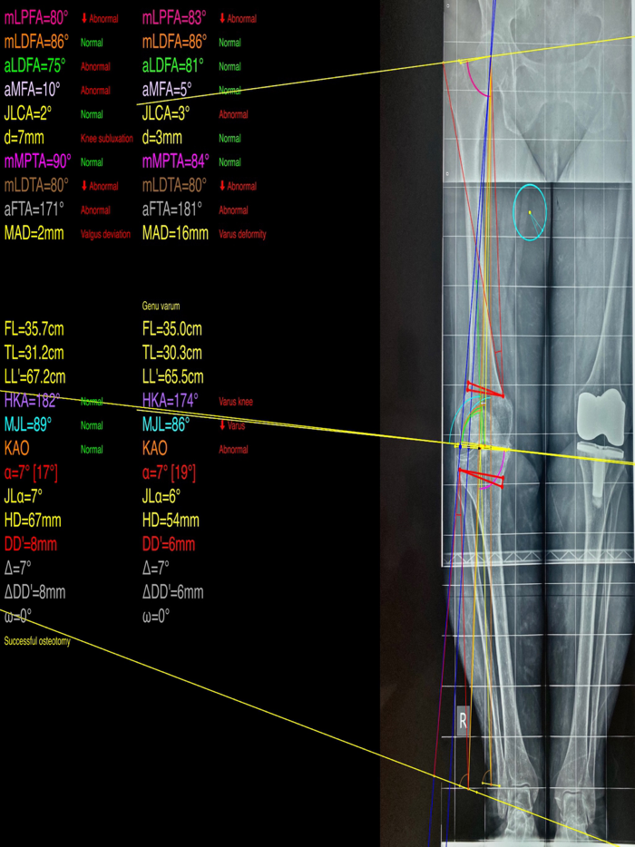 OsteotomyApp