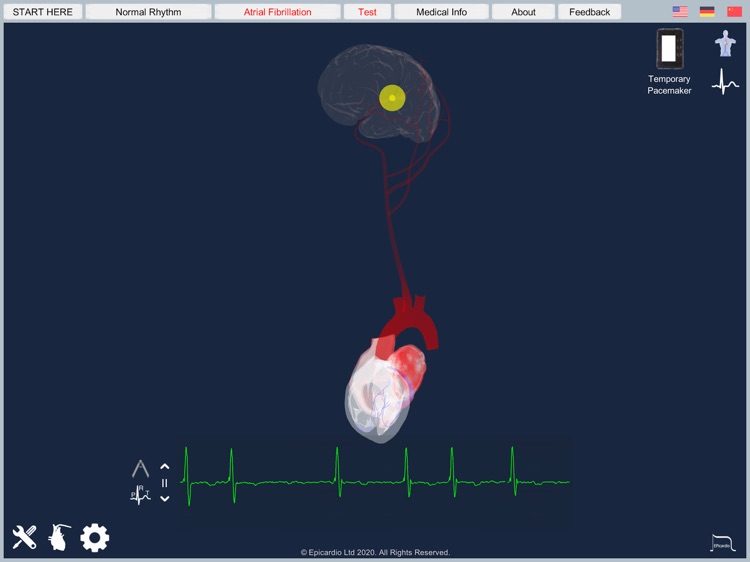 Atrial Fibrillation screenshot-3