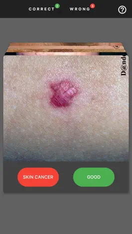 Game screenshot MelanomaExam apk