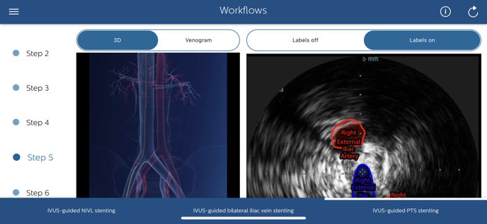 Philips Venous IVUS Tutor