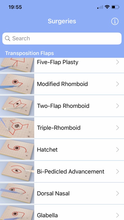 Surgical Flaps