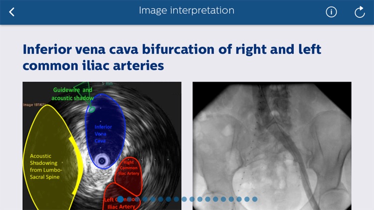 Philips Venous IVUS Tutor