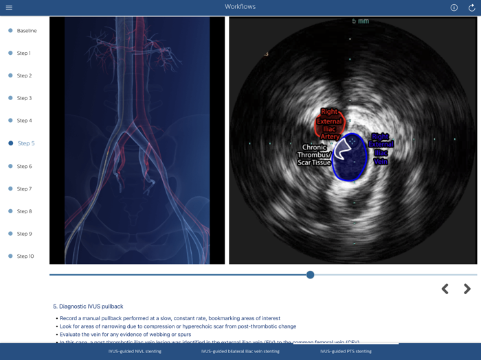 Philips Venous IVUS Tutor