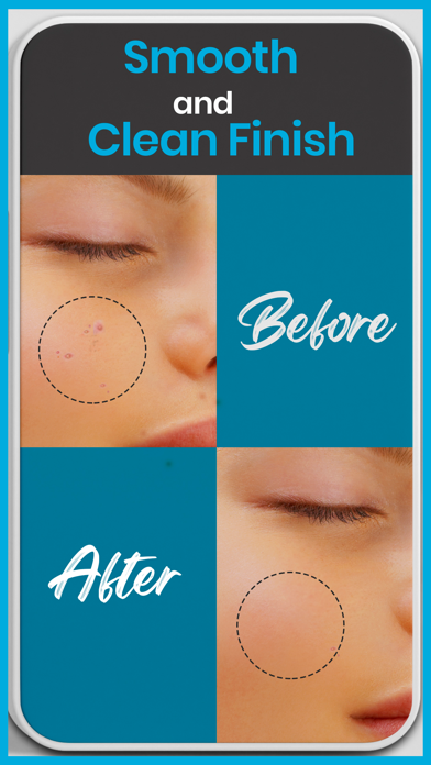 Pimple Remover - Acne Eraser Screenshot