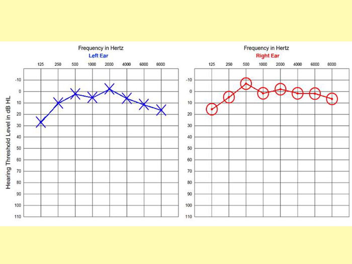 Audiogram Hearing Test