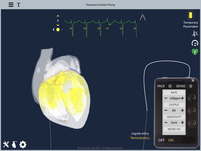 Temporary Cardiac Pacing