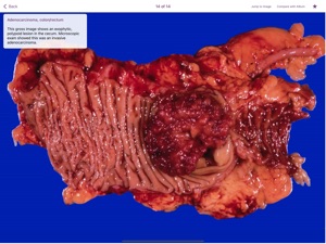 Colonic Pathology screenshot #3 for iPad
