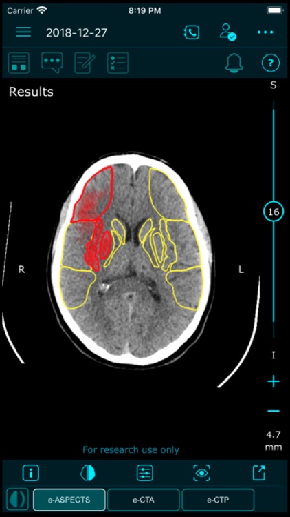 Brainomix 360 Mobile screenshot-3