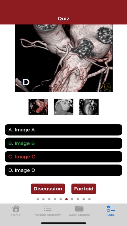 CTisus CT Coronary Arteries screenshot-7