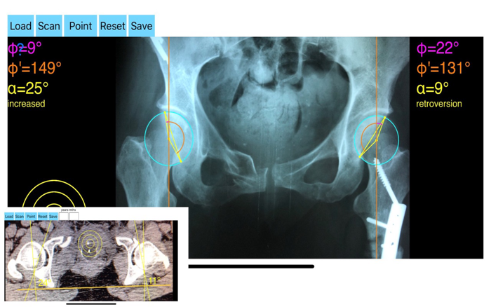 AcetabularAnteversionApp