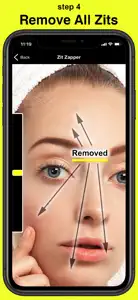 Zit Zapper - Remove Pimples screenshot #5 for iPhone