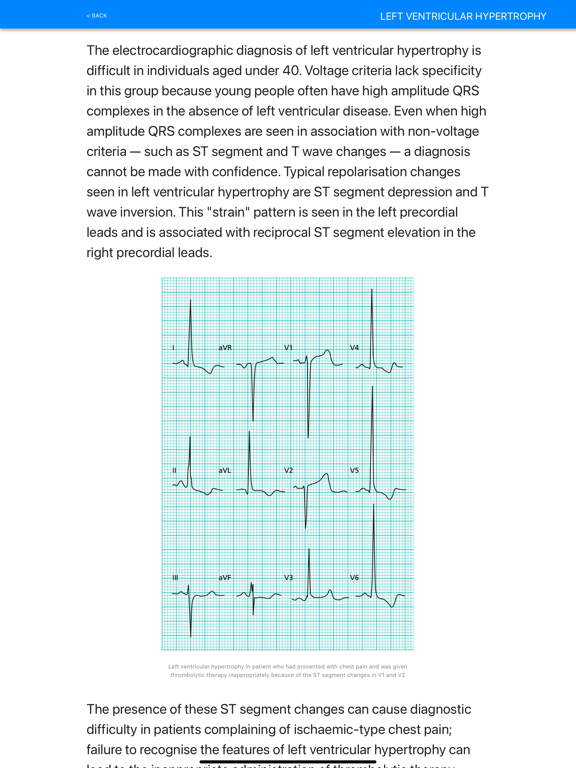 Screenshot #6 pour ECG Basics Pro - ECG Made Easy