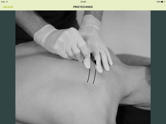 Dry Needling Guide iPad app afbeelding 3