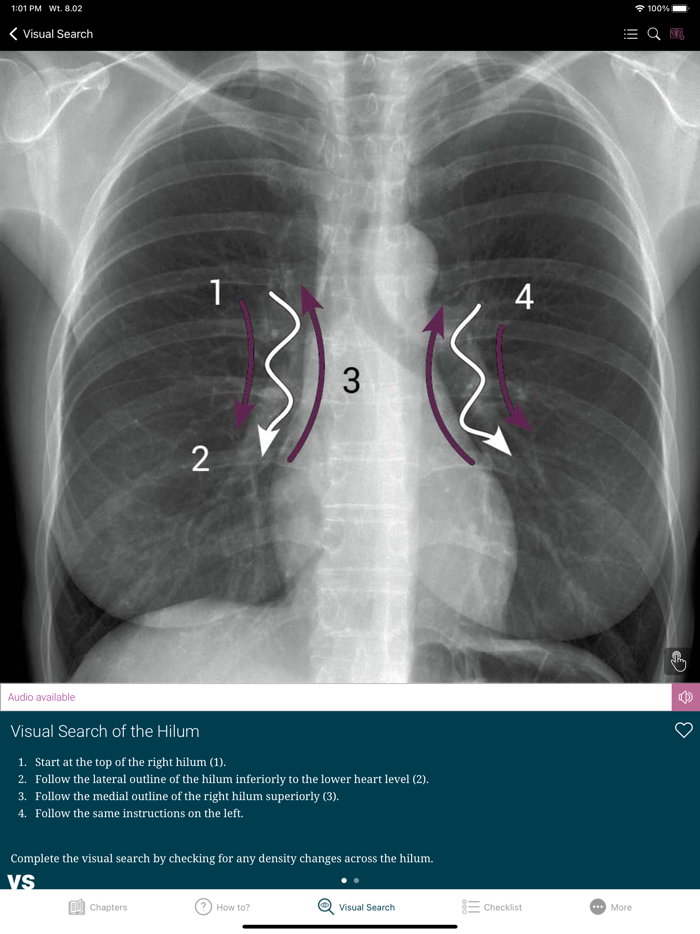 Chest X-ray Interpretation