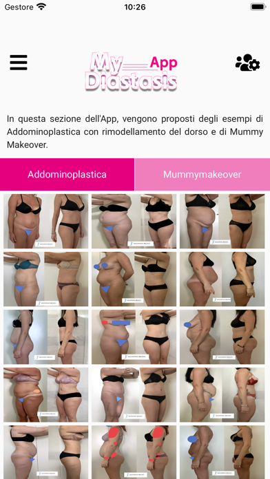 myDiastasisApp Screenshot