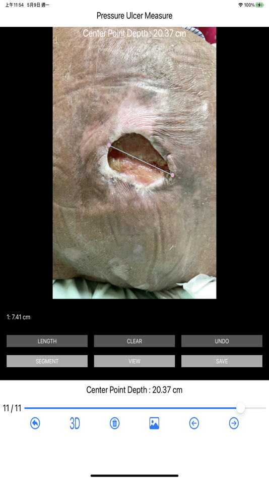 #3. Pressure Ulcer Measure (iOS) Podle: HAN WEI WANG