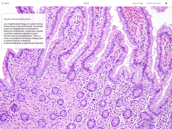 Screenshot #6 pour Small Intestinal Pathology