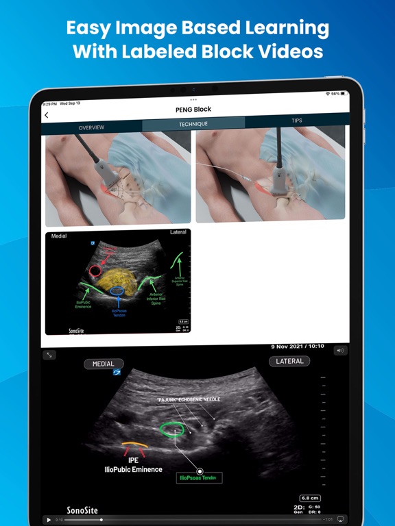 Screenshot #6 pour PNBschool Anesthesia Blocks