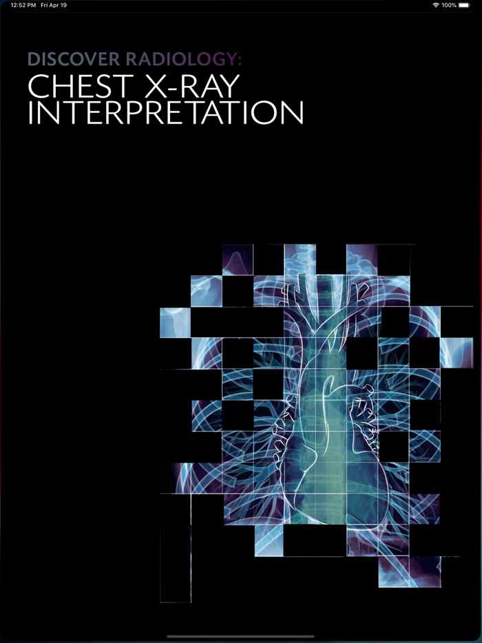 Chest X-ray Interpretation