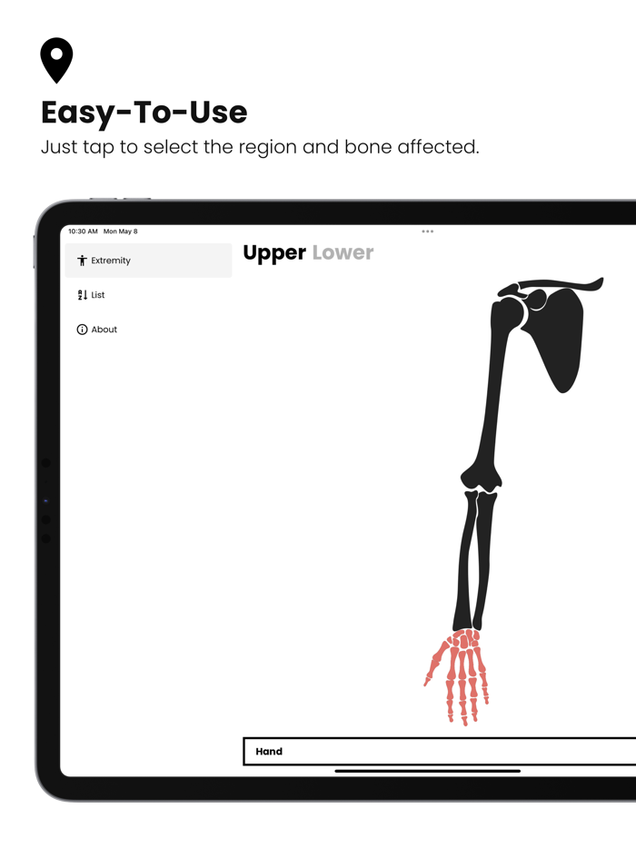 Fractures Splinting App
