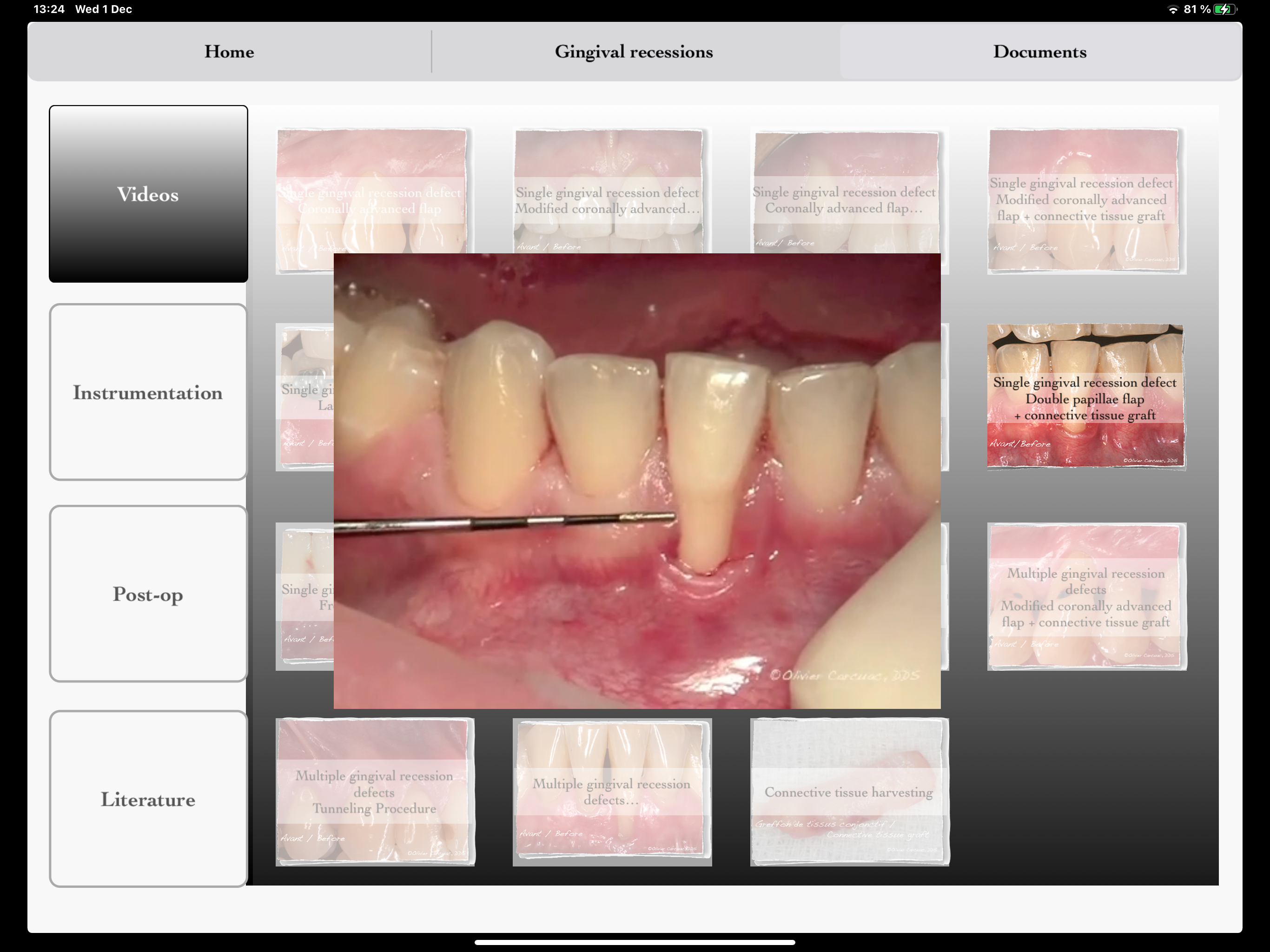 iMuco Gingival recessions screenshot 4