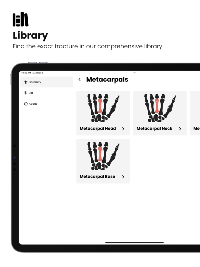 Fractures Splinting App