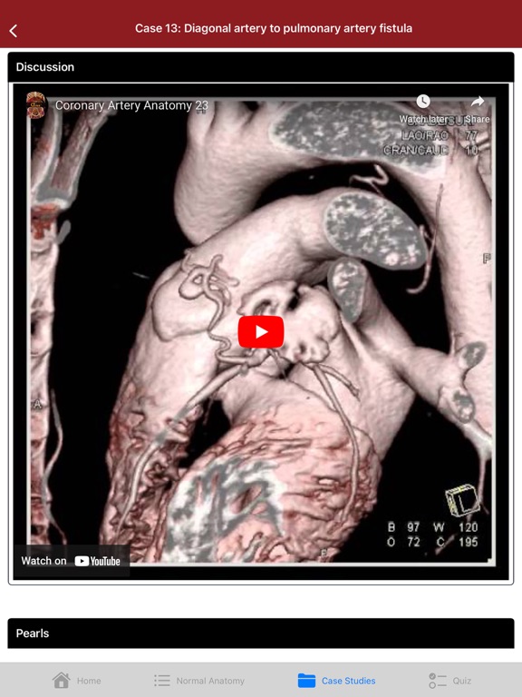 CTisus CT Coronary Arteries iPad screenshot 6 - Medical app