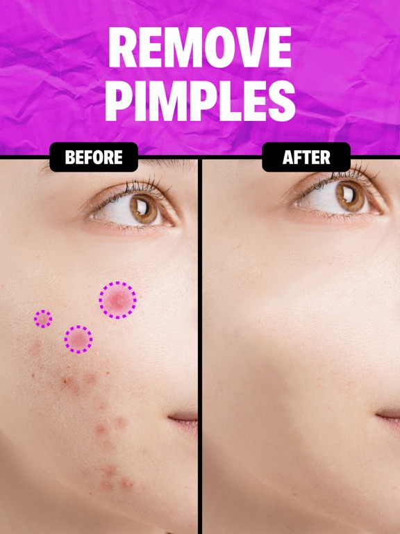 Screenshot #6 pour Remove Object & Erase Pimples