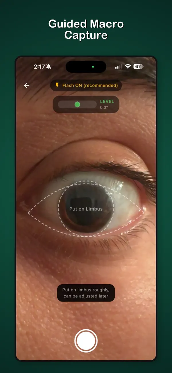 Screenshot #3 pour Toric IOL