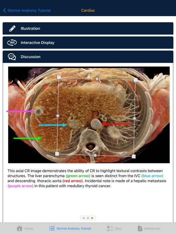 CTisus Chest Atlas 3D CRT iPad screenshot 5 - Medical app