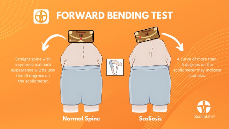 Scoliometer screenshot-4