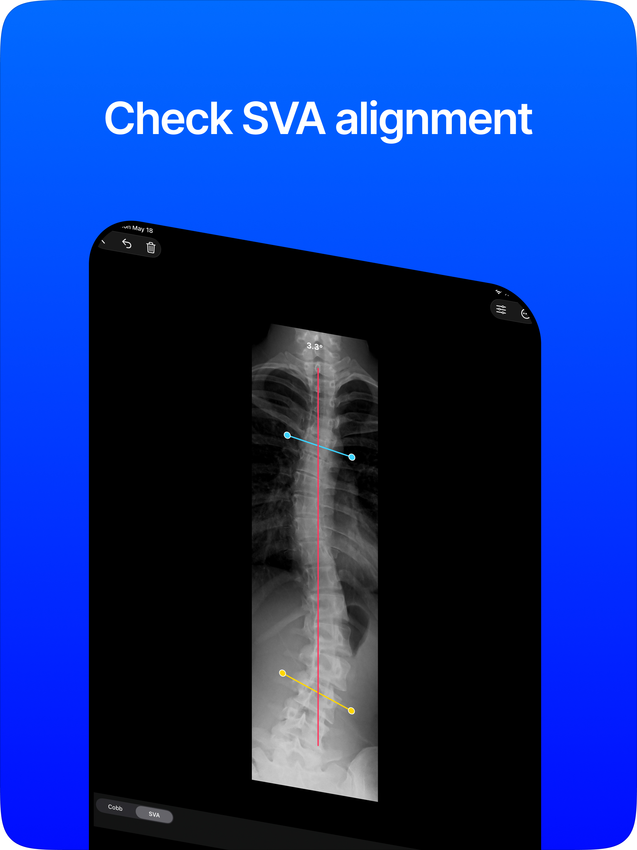 Cobb Angle Pro Spine X-Ray