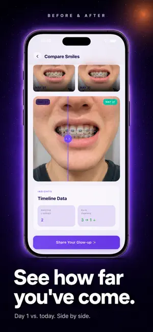 Bracer: Orthodontic Tracker screenshot 1