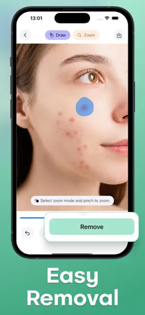 Acne Remover - Pimple Eraser screenshot 2