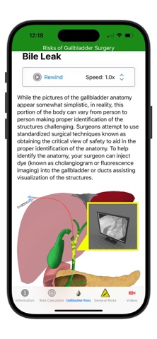 Gallbladder Surgery Risks screenshot