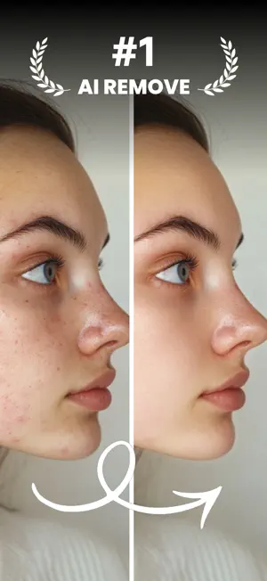 Blemish Remover : AI Remove screenshot 1
