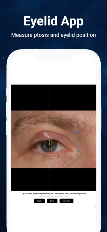 Eyelid, Ptosis, Blepharoplasty screenshot 2 of 3